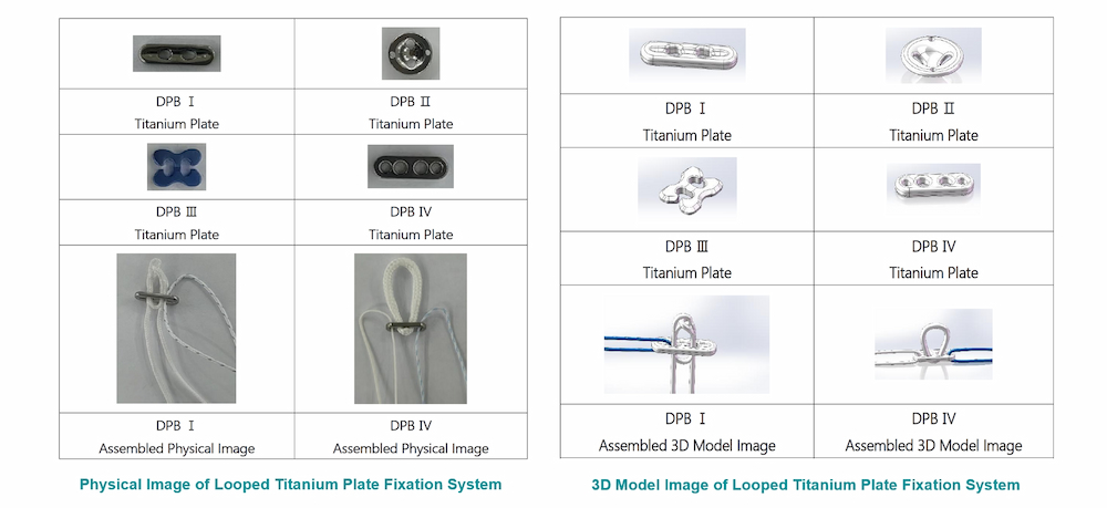 Looped Titanium Plate Fixation System